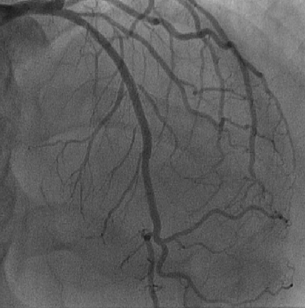 Resultado final após implante do stent